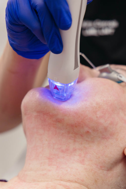 What Is Radiofrequency Microneedling for Skin Tightening?