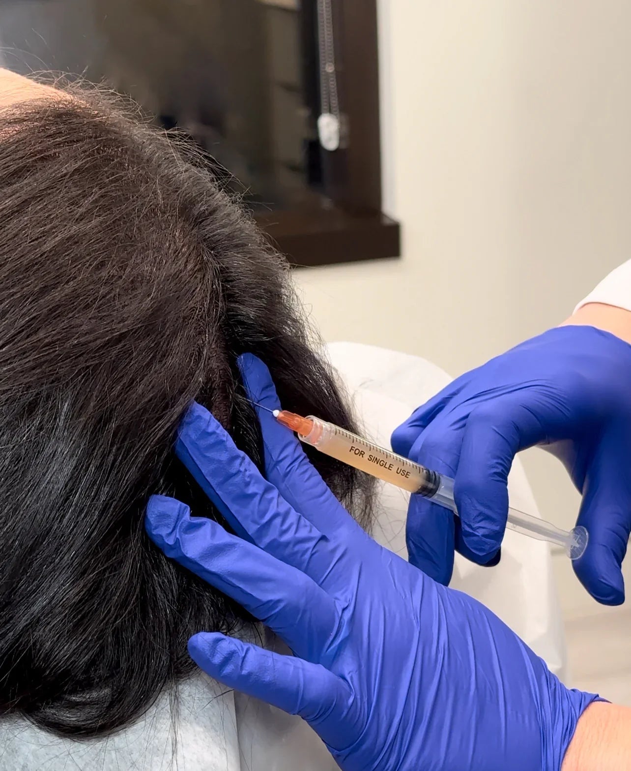 Effective Hair Loss Treatments in Northern Virginia