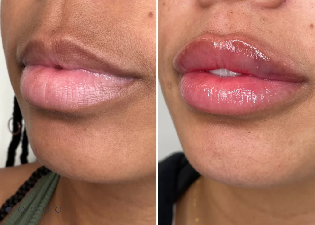 Lip Filler in Arlington, VA: Your Comprehensive Guide to Lip Filler + Choosing the Right Injector