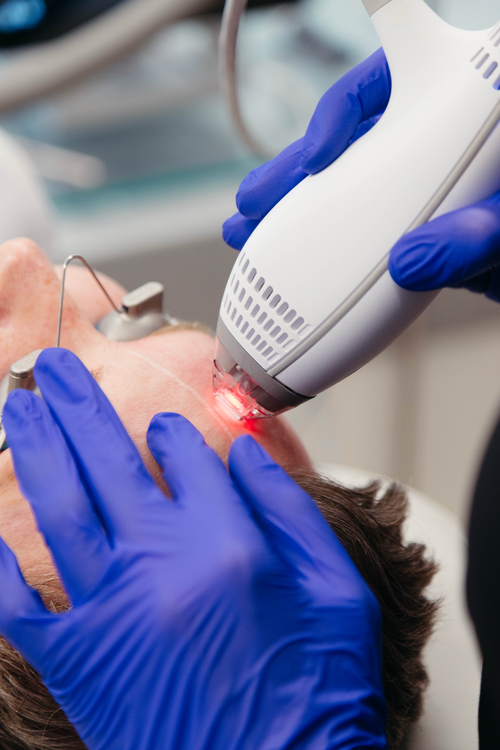 Best Laser Treatment for Broken Capillaries