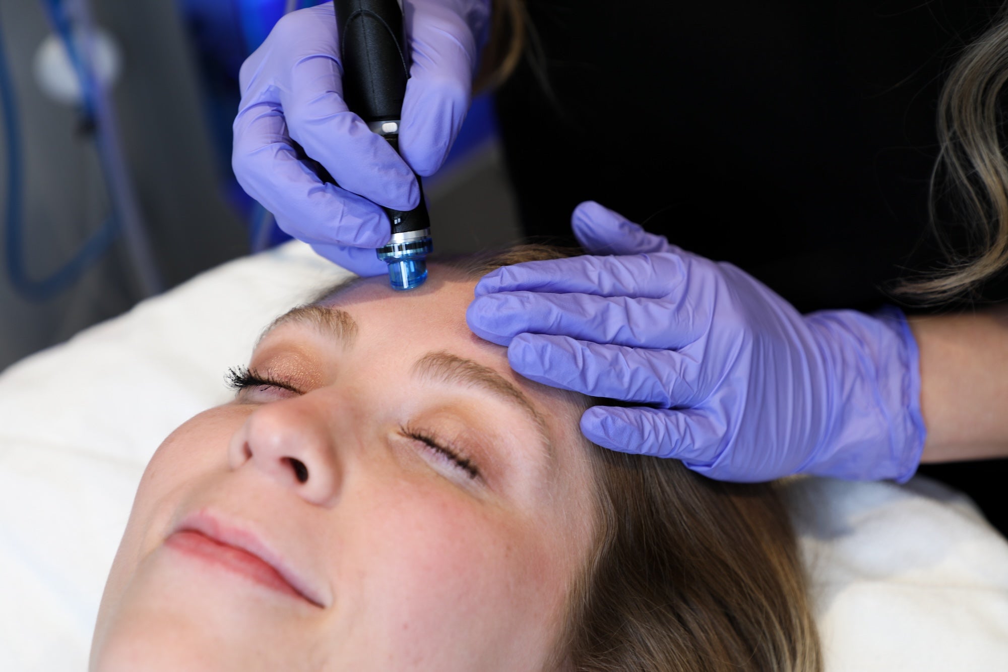 close up of hydrafacial on forehead