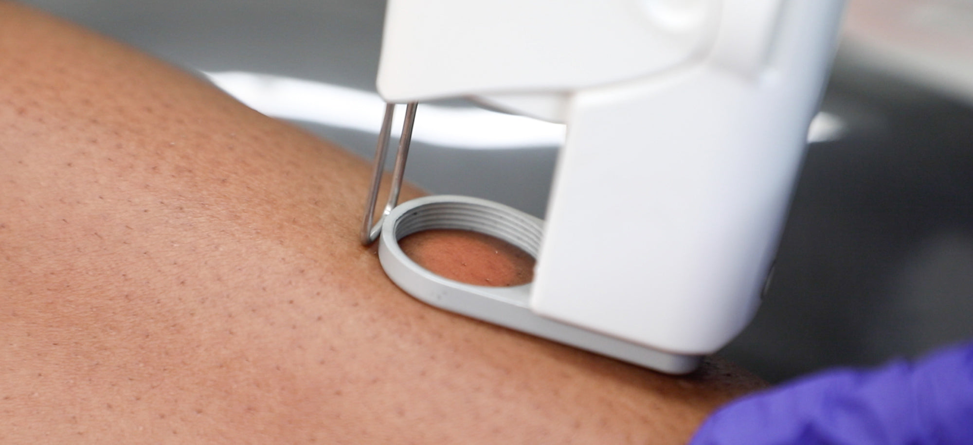 laser hair removal on leg
