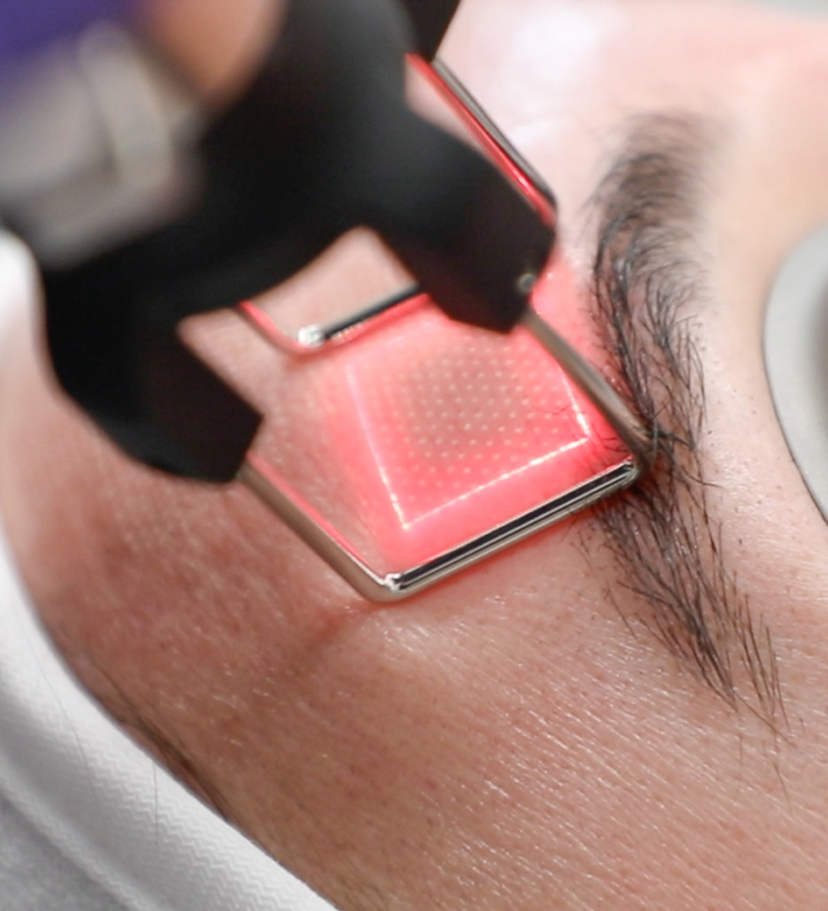 Laser treatment on forehead