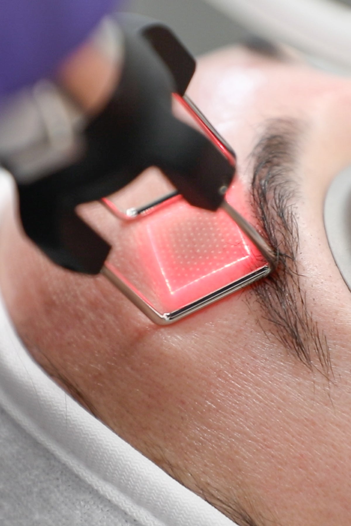 Laser treatment on forehead