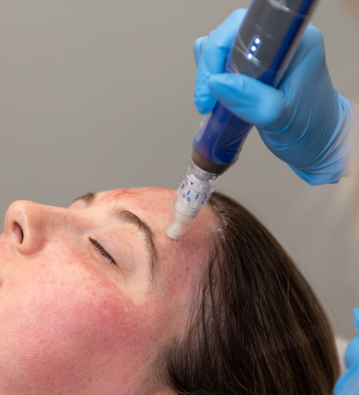 Skinpen treatment on woman's forehead