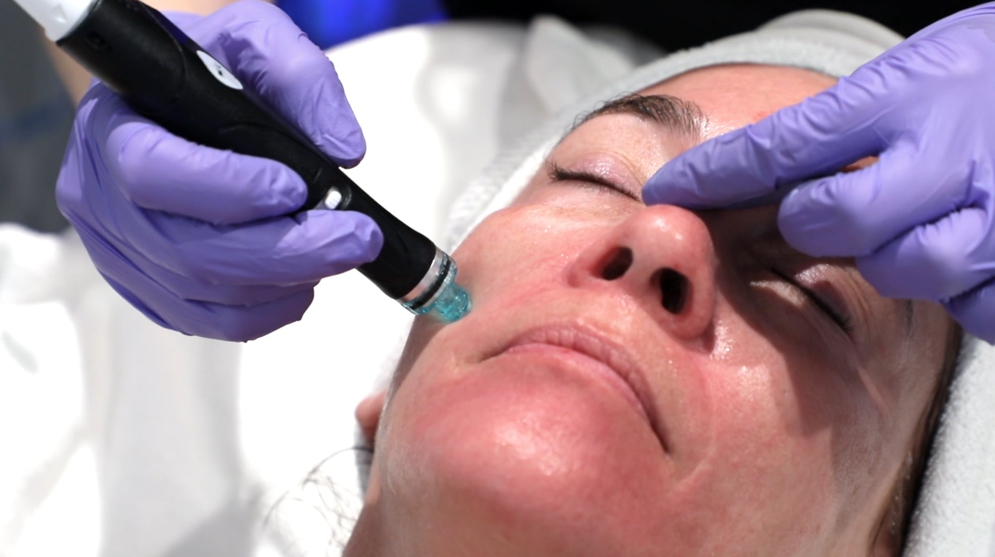 up close of hydrafacial on face