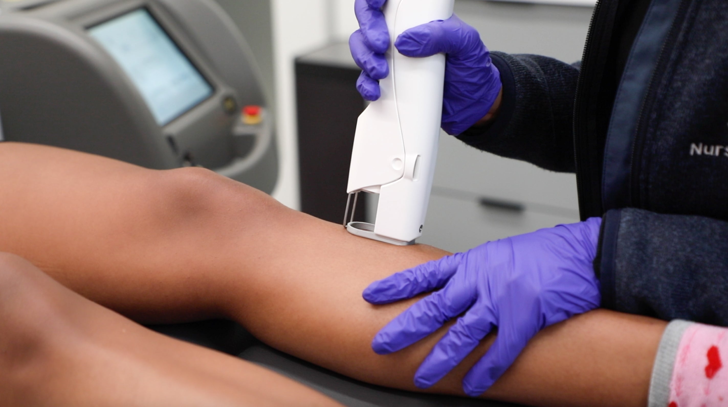 laser hair removal on leg