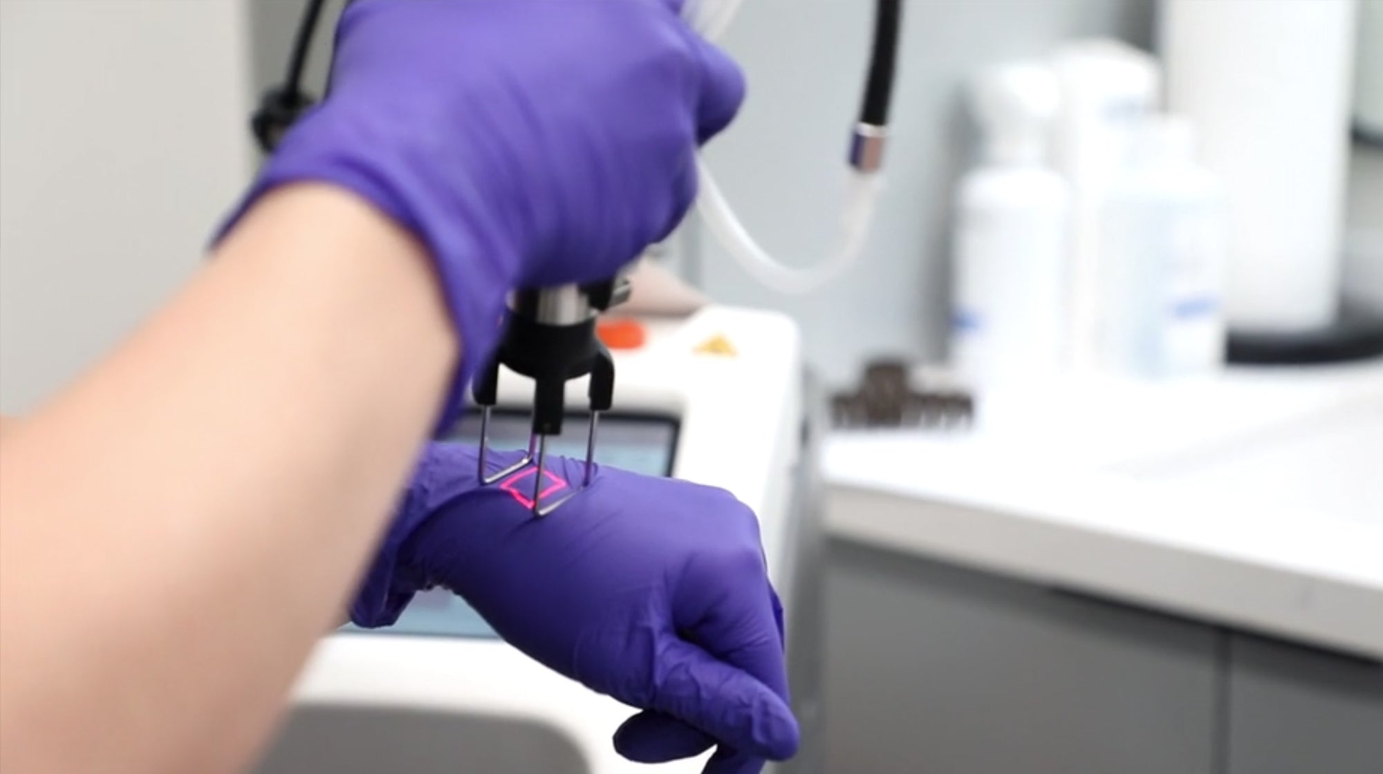 provider testing laser treatment on hand