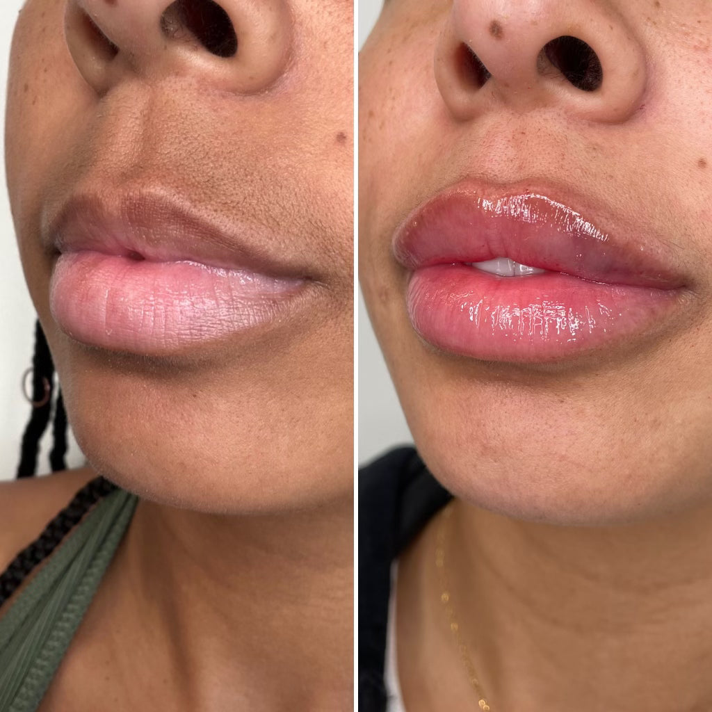 lips lina before and after