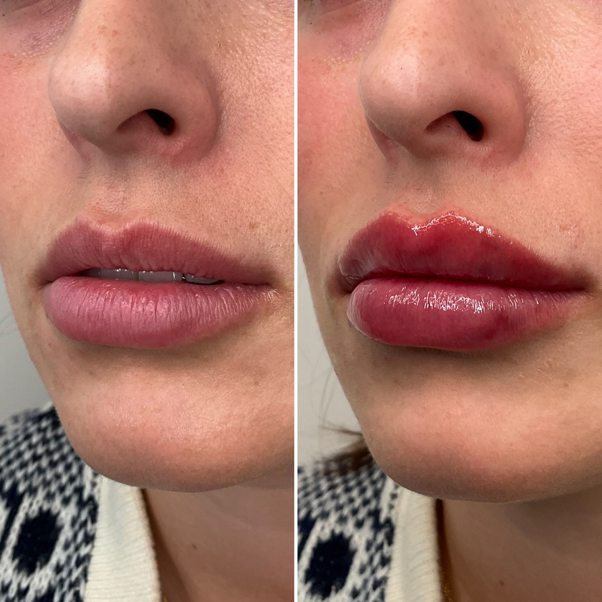 lip filler before and after