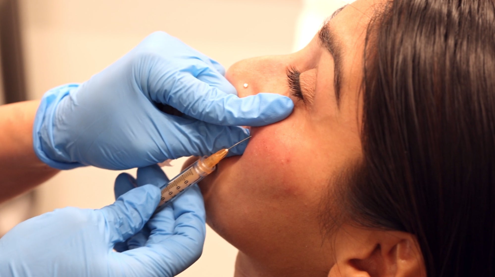 injecting near patient's upper cheek