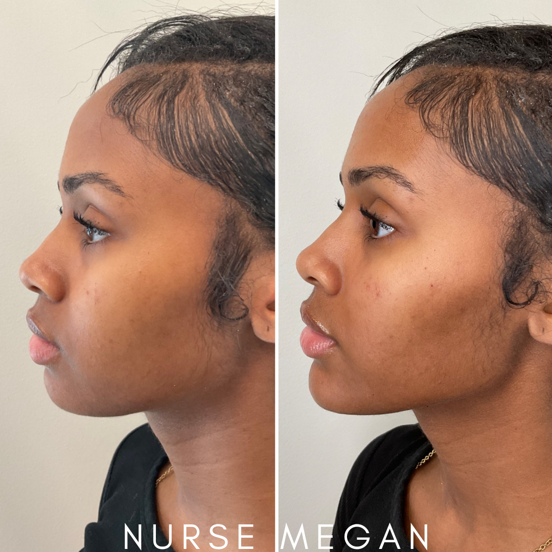 facial balancing side view