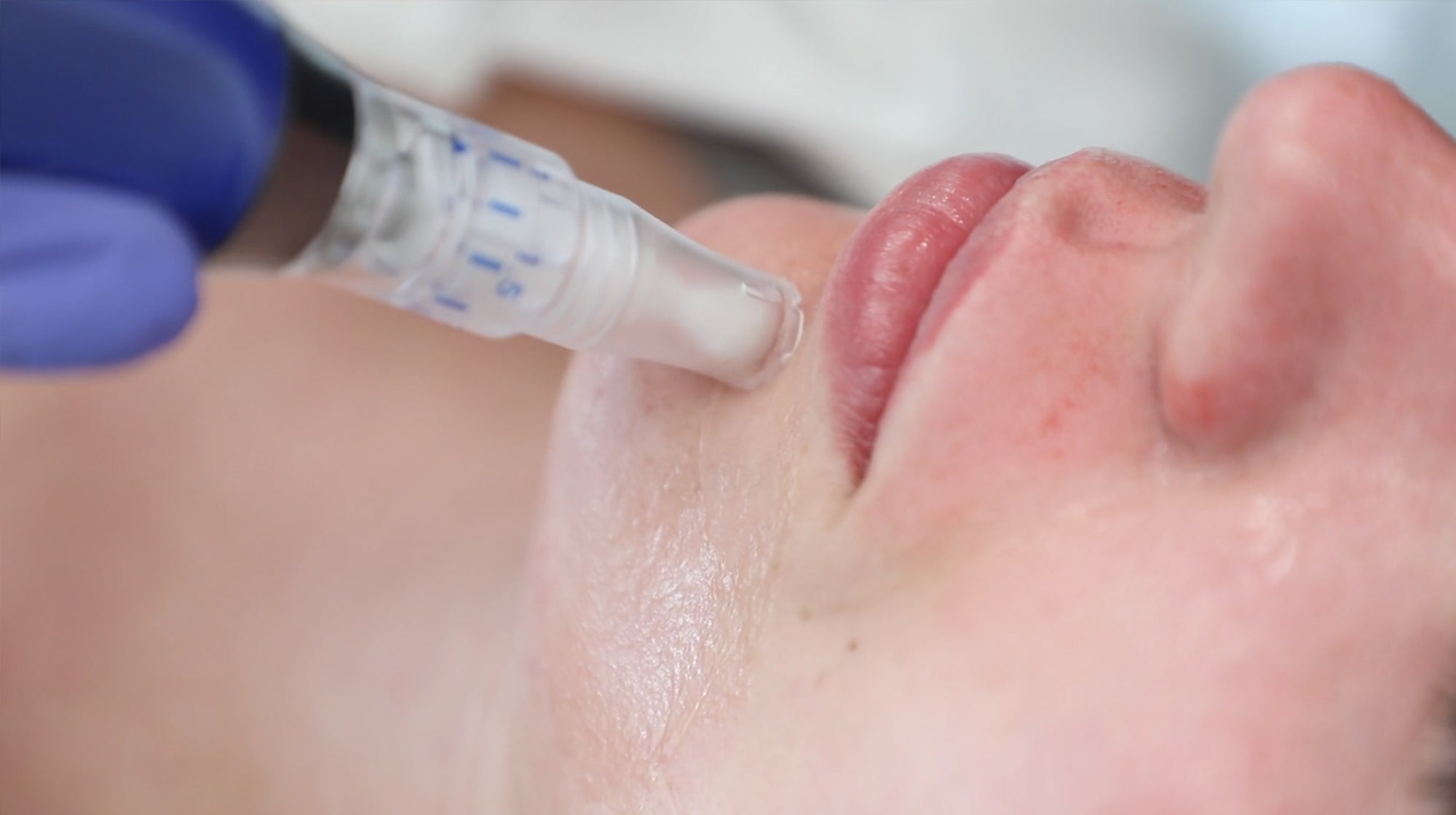 skinpen under patient's lip