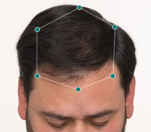 scalp after nutrafol