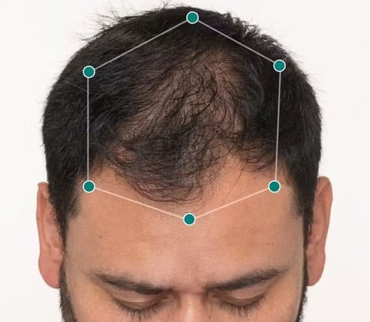 scalp before nutrafol