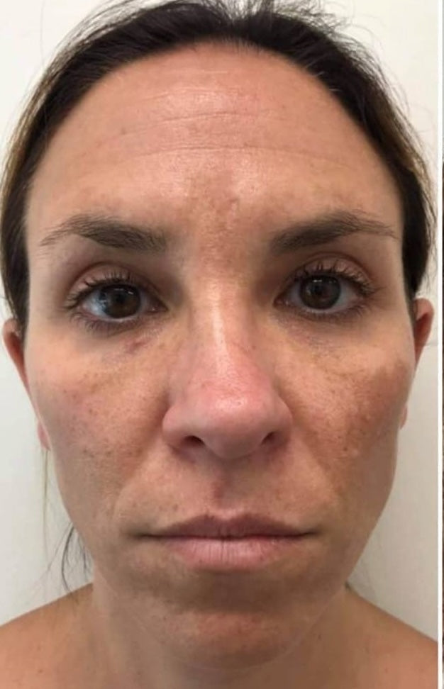 microneedling before treatment