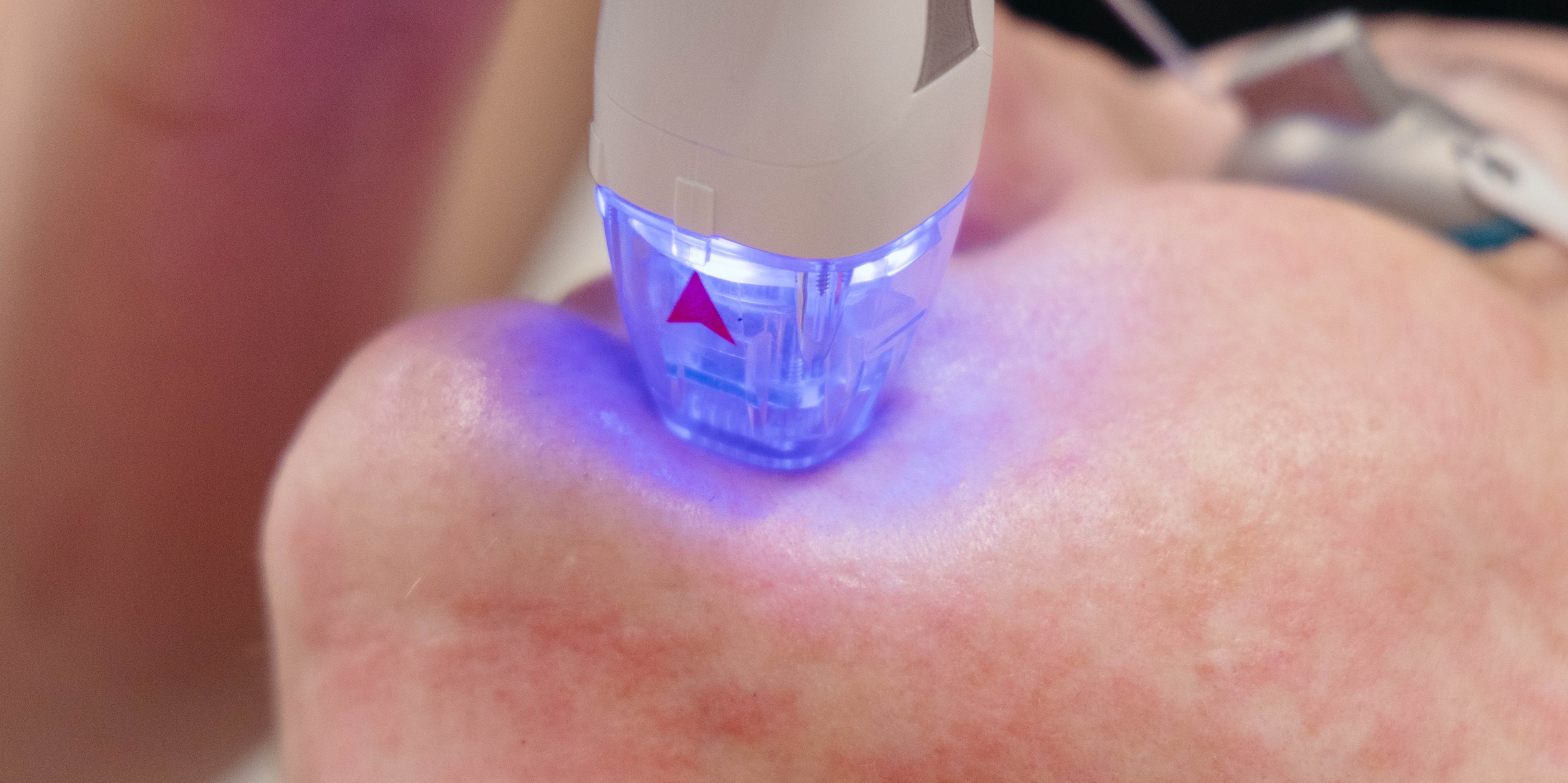 What Is Radiofrequency Microneedling for Skin Tightening?