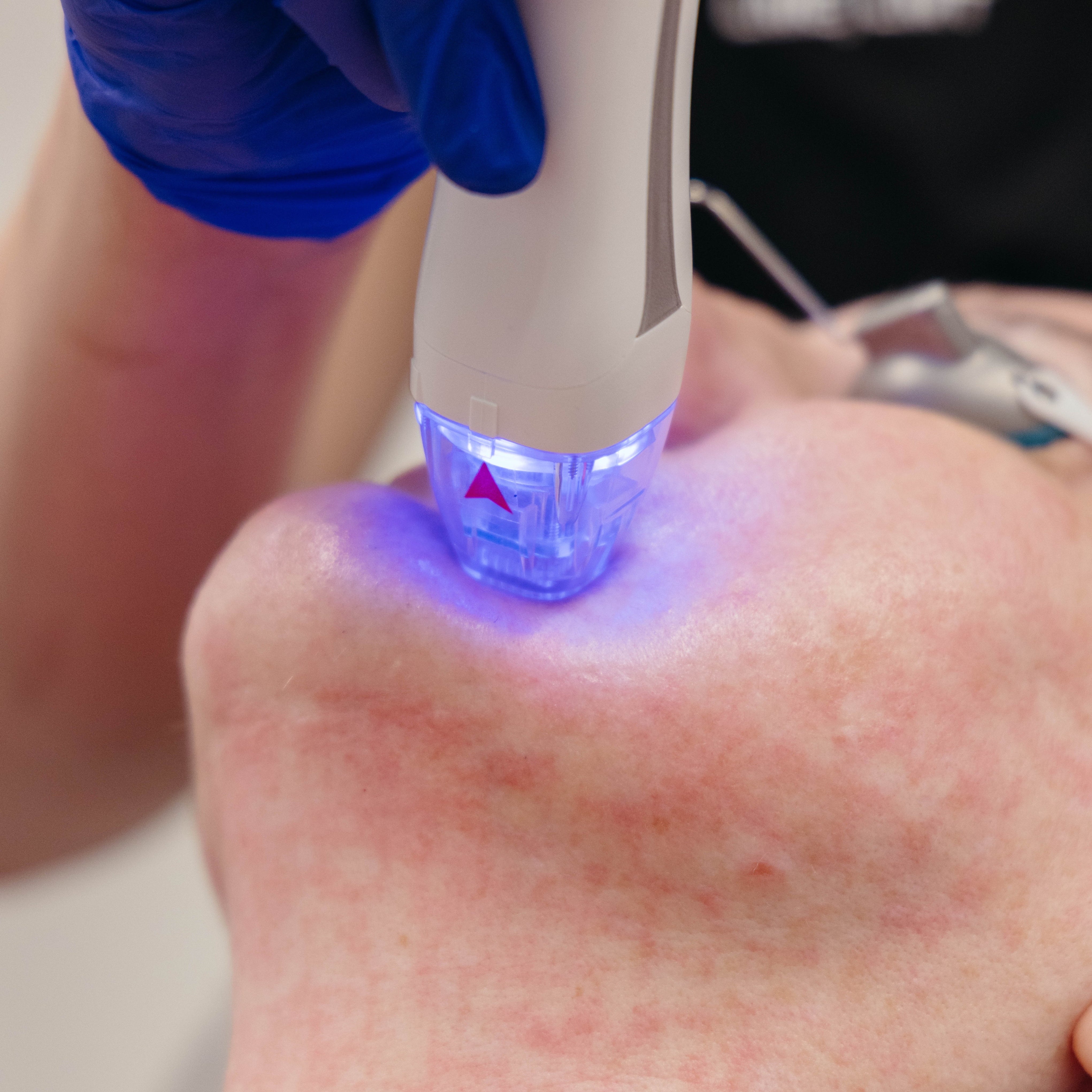 What Is Radiofrequency Microneedling for Skin Tightening?