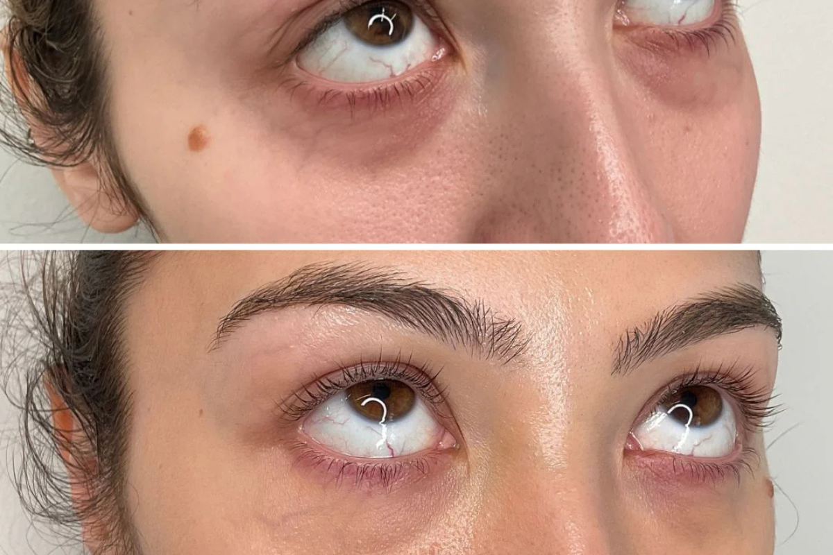 PRF Under Eyes: How It Can Reduce Dark Circles & Rejuvenate Your Skin