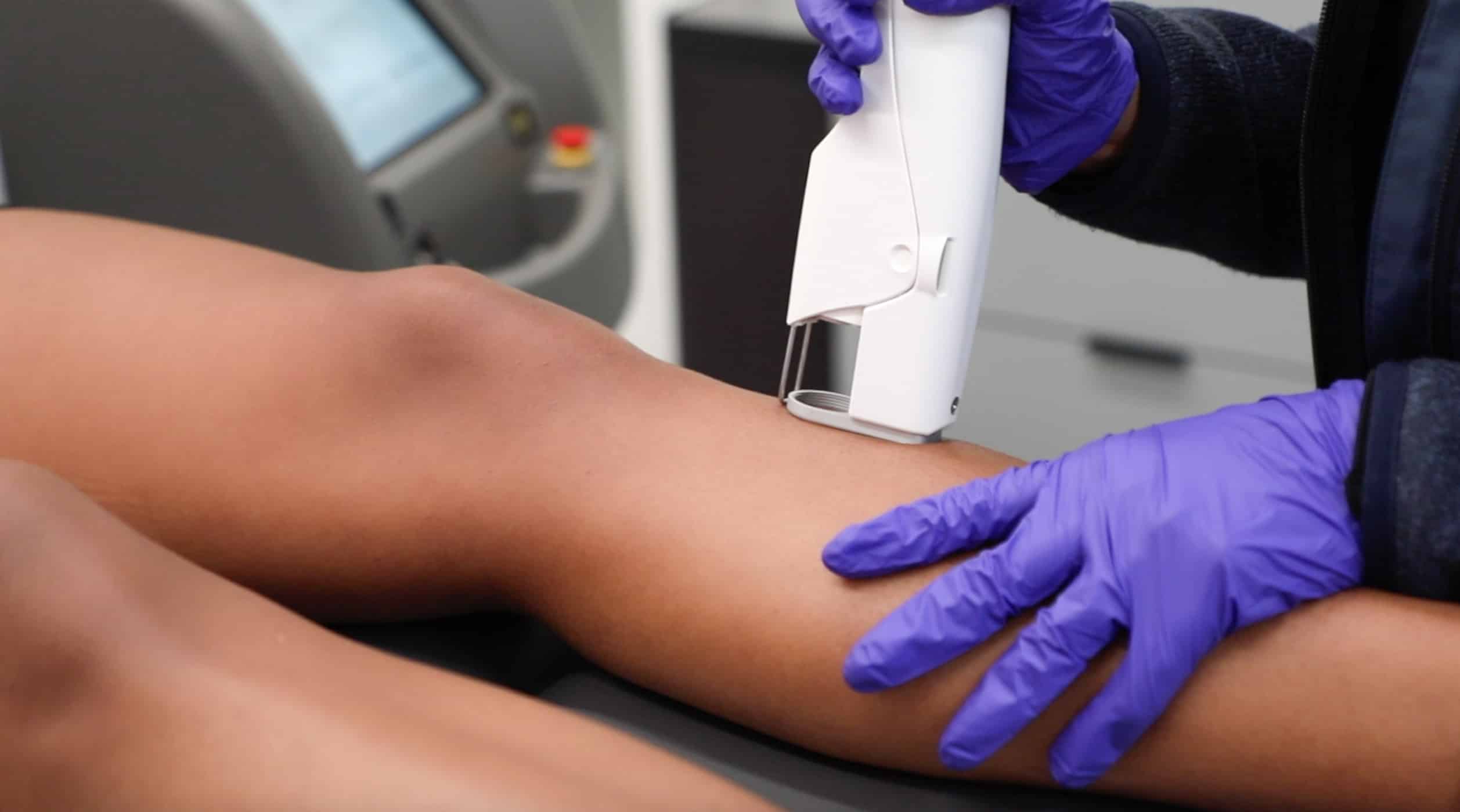 How Long Does Laser Hair Removal Last?