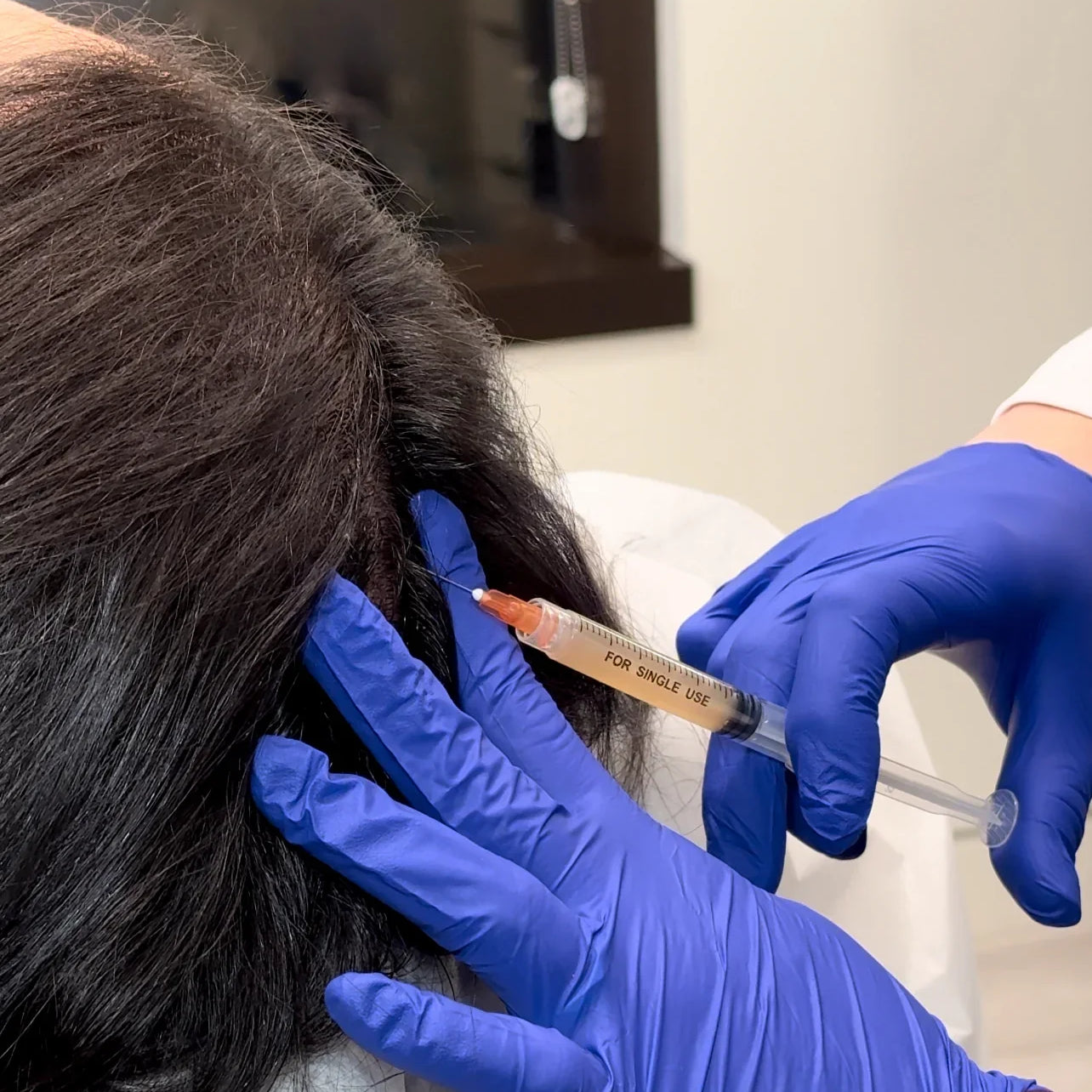 Effective Hair Loss Treatments in Northern Virginia