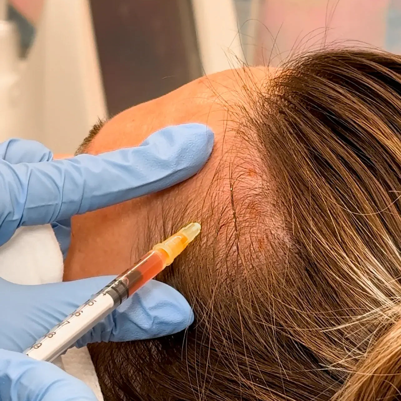 PRF for Hair Restoration: Thicker, Healthier Hair
