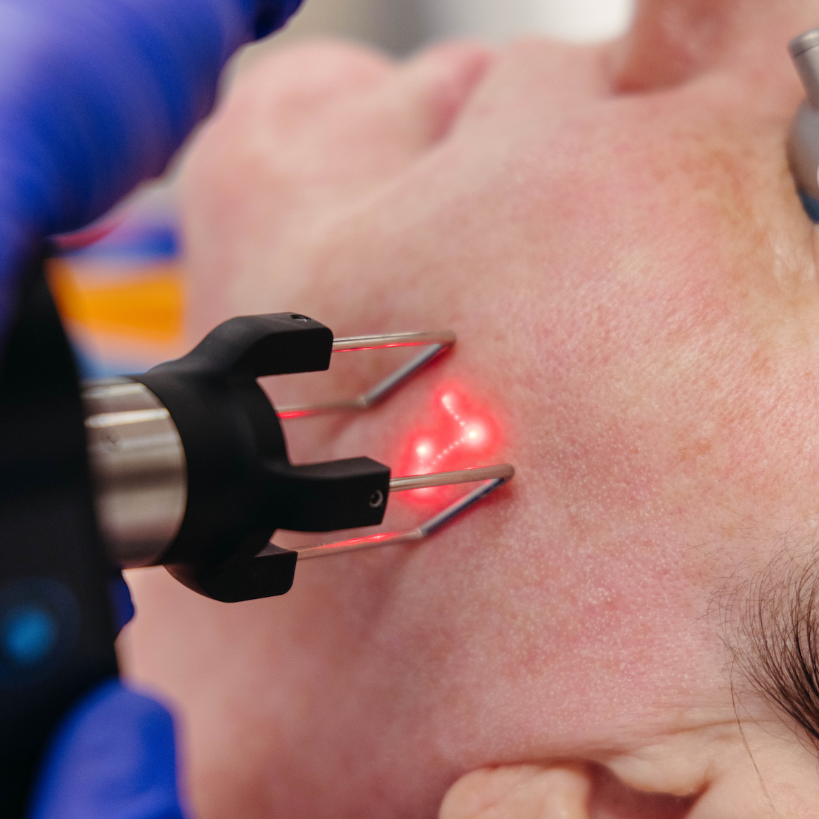 How Do CO2 Laser Treatments Improve Skin Texture and Tone?
