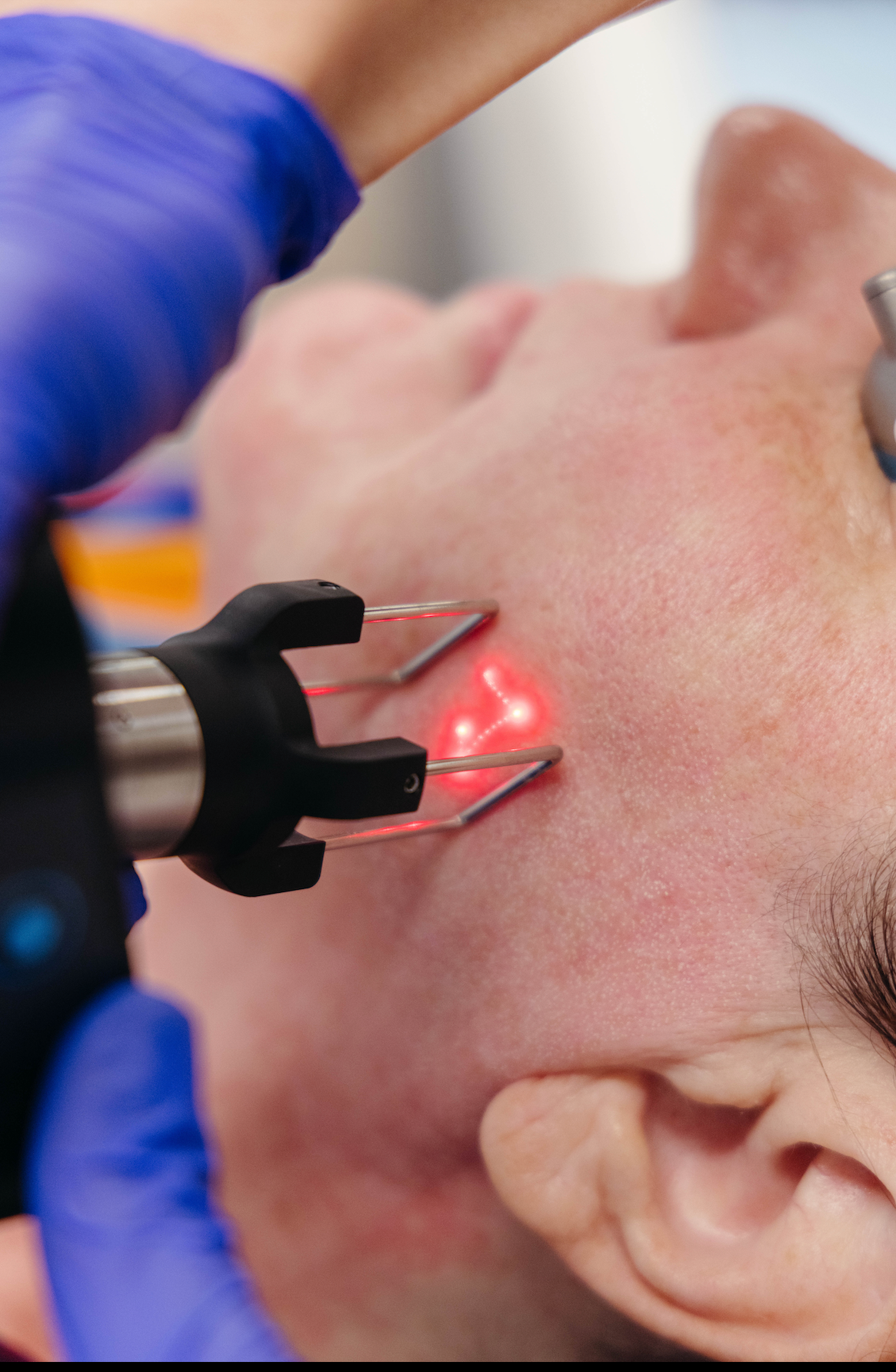 How Do CO2 Laser Treatments Improve Skin Texture and Tone?