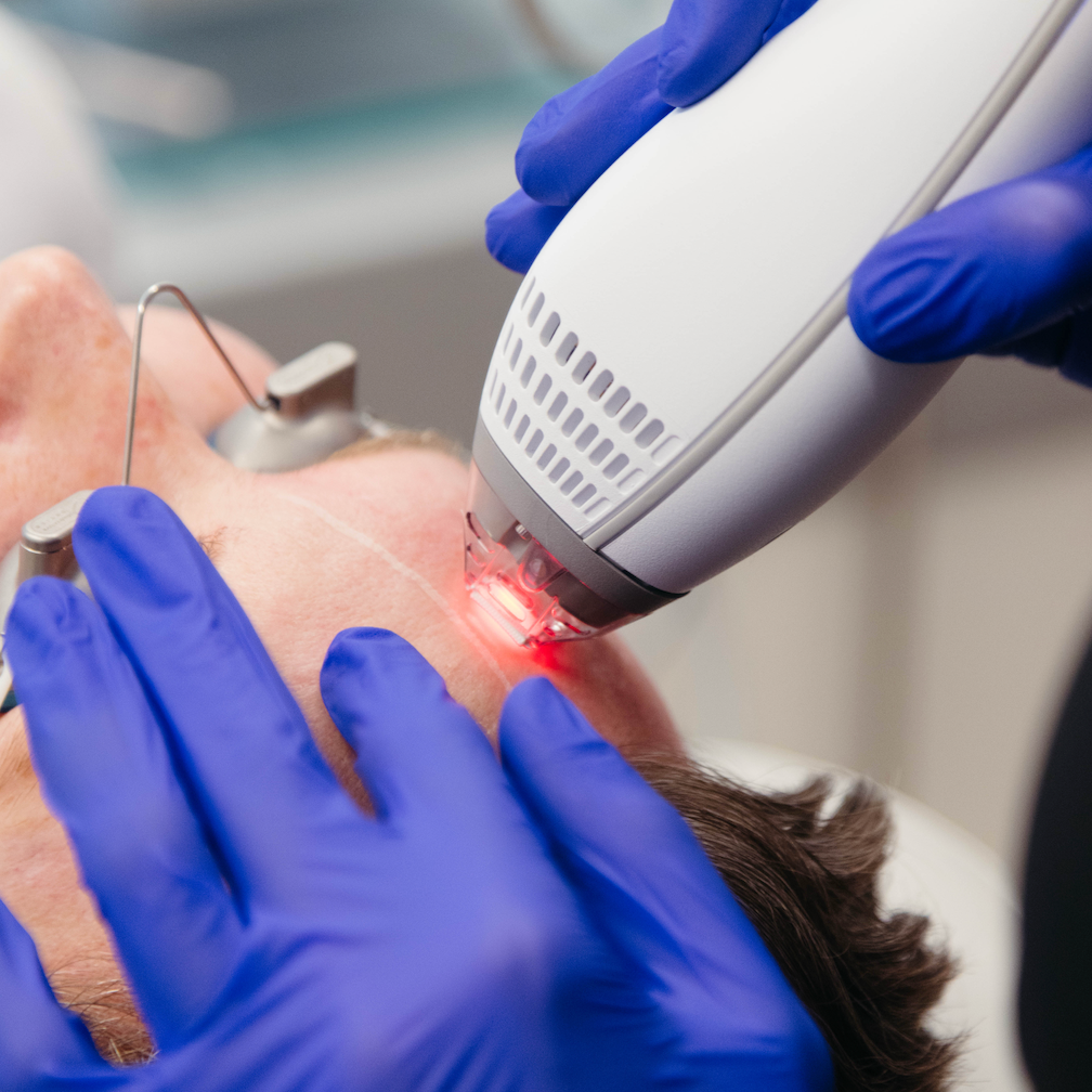 Best Laser Treatment for Broken Capillaries