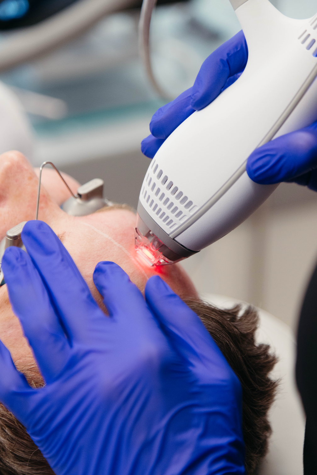 Best Laser Treatment for Broken Capillaries