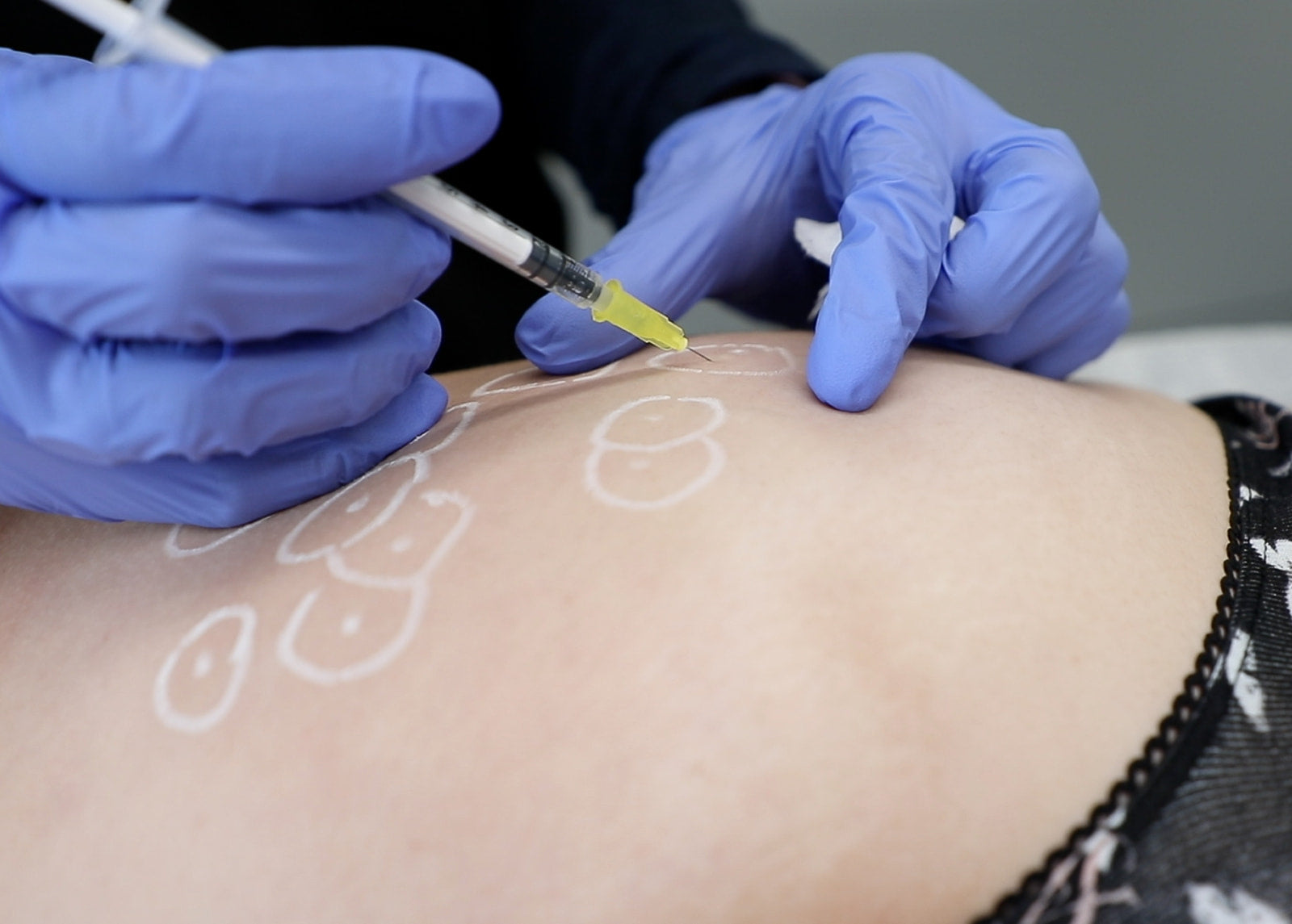 Botox for Excessive Sweating: Could It Be the Solution?
