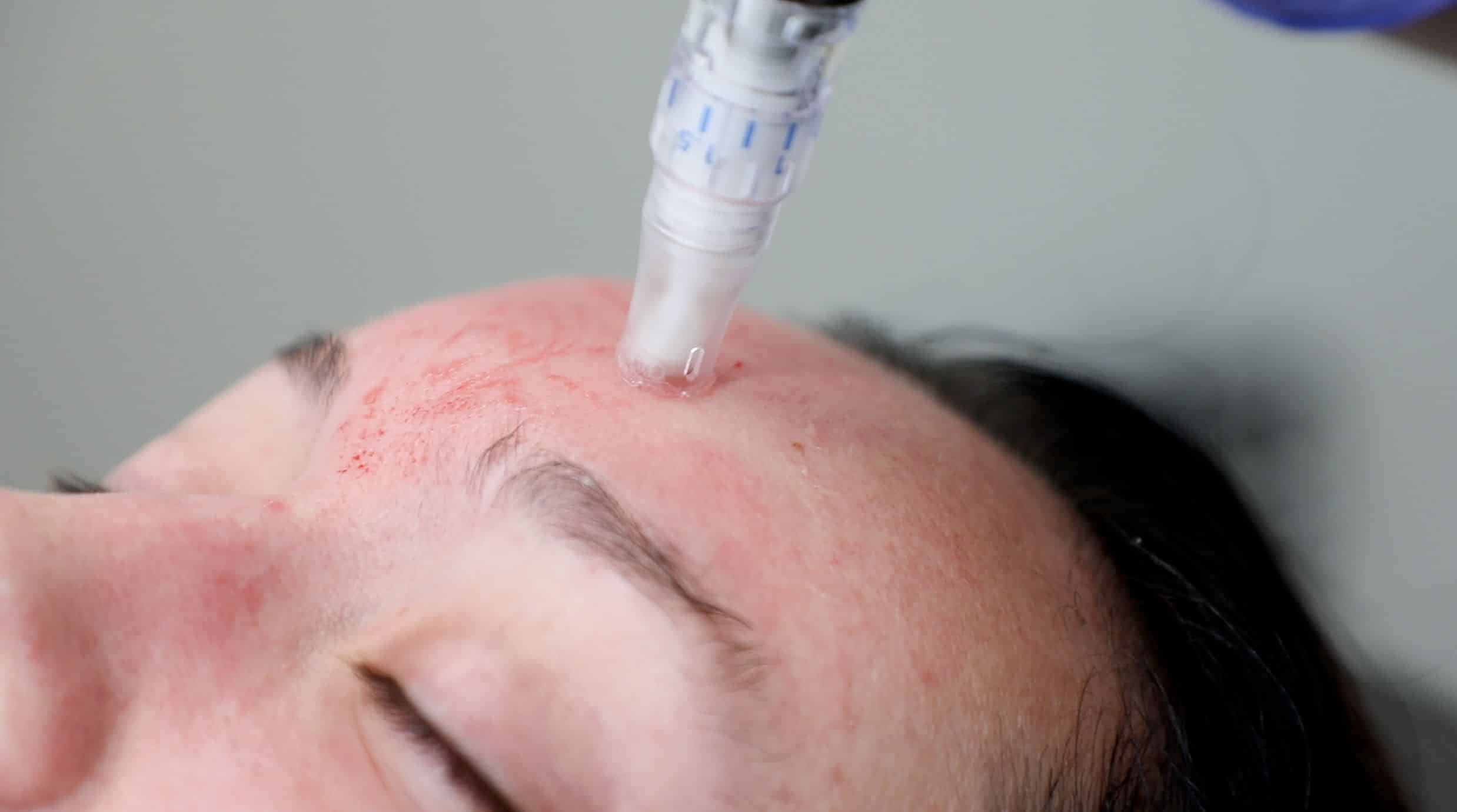 Can Microneedling Help with Wrinkles?