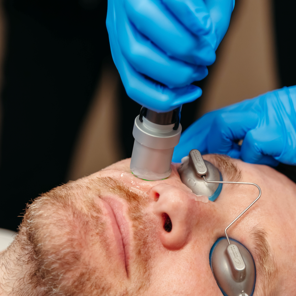 What Is the Best Laser Treatment for Rosacea