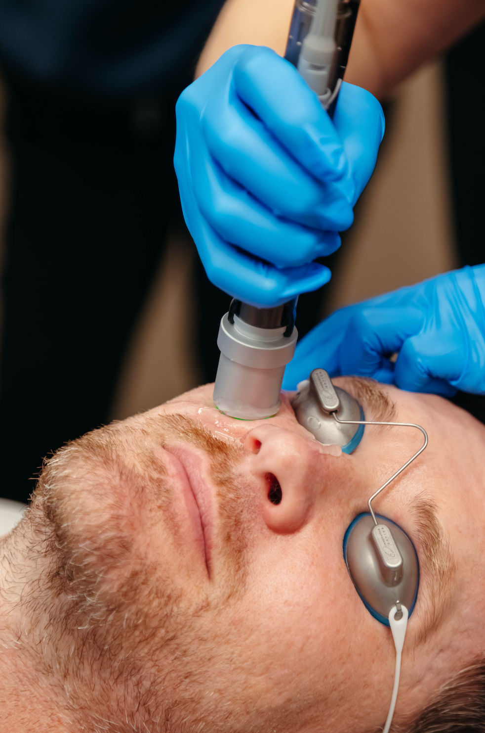 What Is the Best Laser Treatment for Rosacea