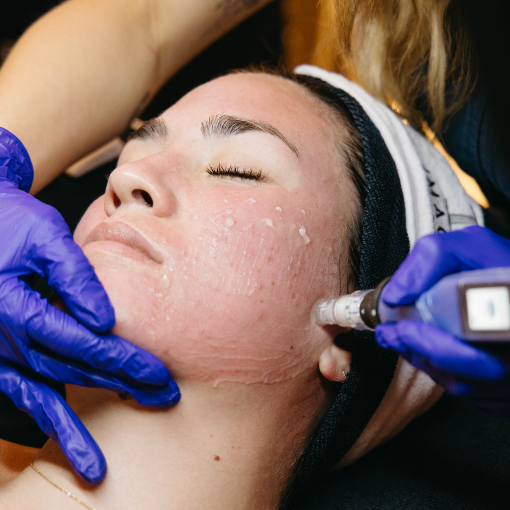 What Causes Melasma & How to Treat It?