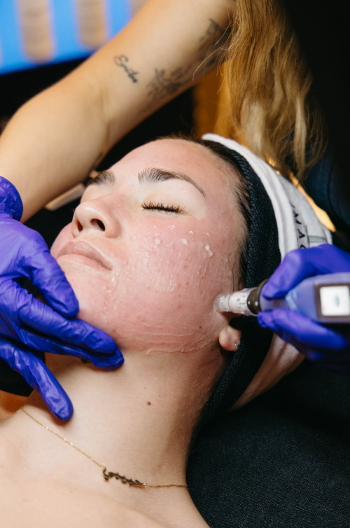 What Causes Melasma & How to Treat It?