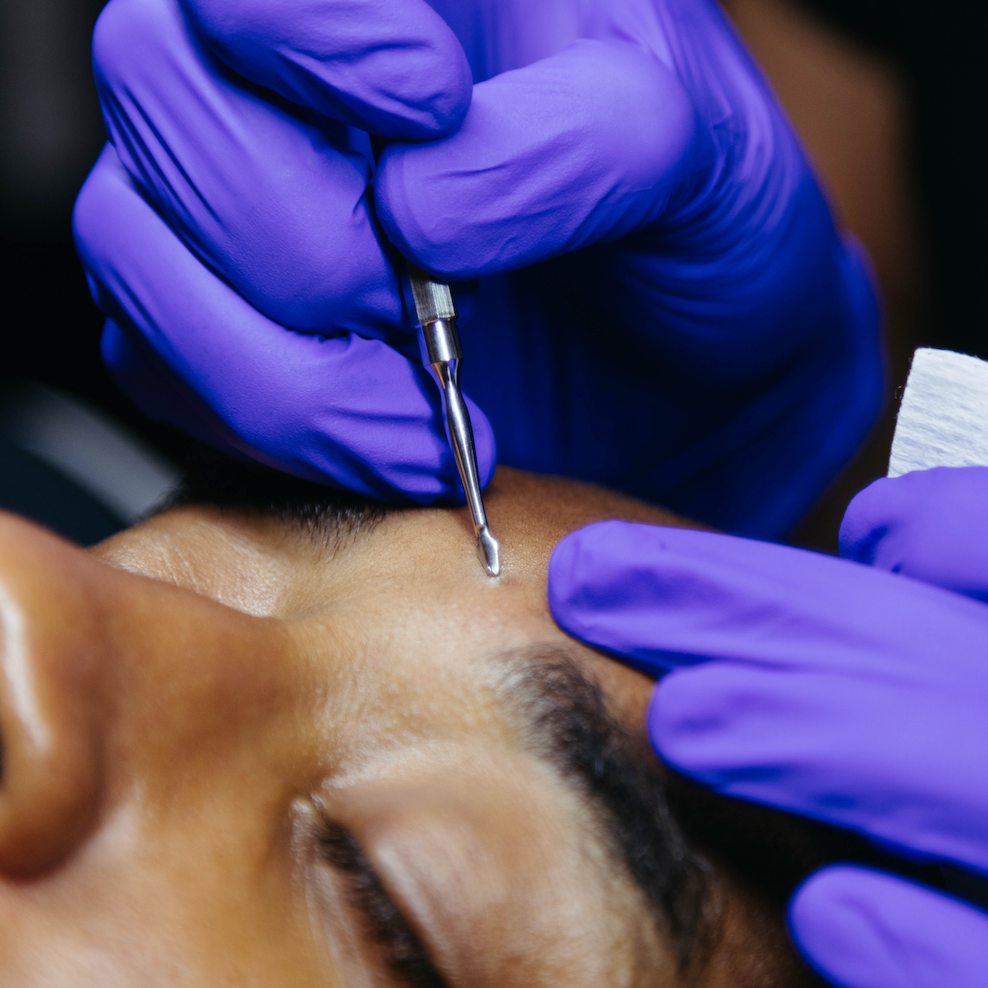 When Should You Get a HydraFacial Before Your Wedding?
