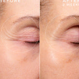 Before and after comparison of eye area treatment showing reduced puffiness.