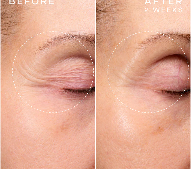 Before and after comparison of eye area treatment showing reduced puffiness.