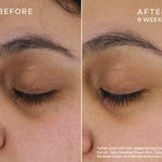 Before and after comparison of eye area treatment showing improved skin texture and reduction of fine lines.