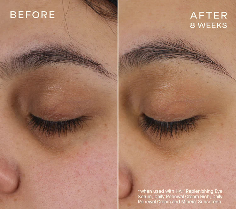 Before and after comparison of eye area treatment showing improved skin texture and reduction of fine lines.