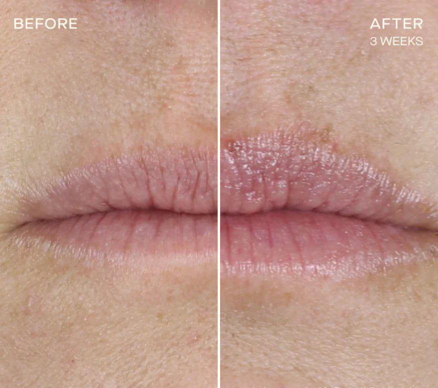 Before and After of Lip Plumping Enhancing Regimen