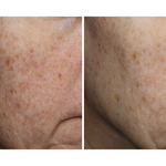 Before and after comparison of skin texture on a person's cheek.