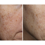 Before and after comparison of skin texture on a person's cheek.