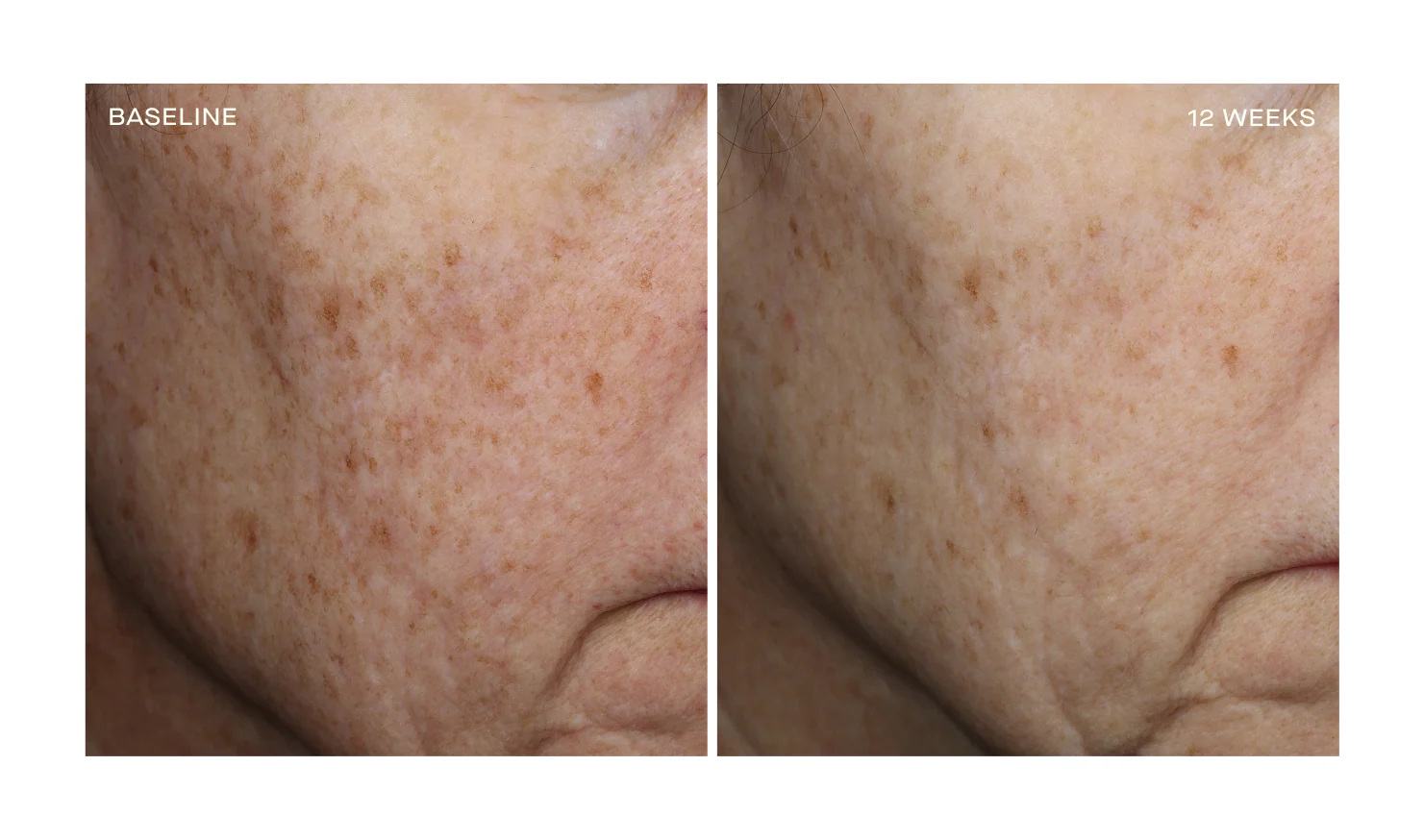 Before and after comparison of skin texture on a person's cheek.