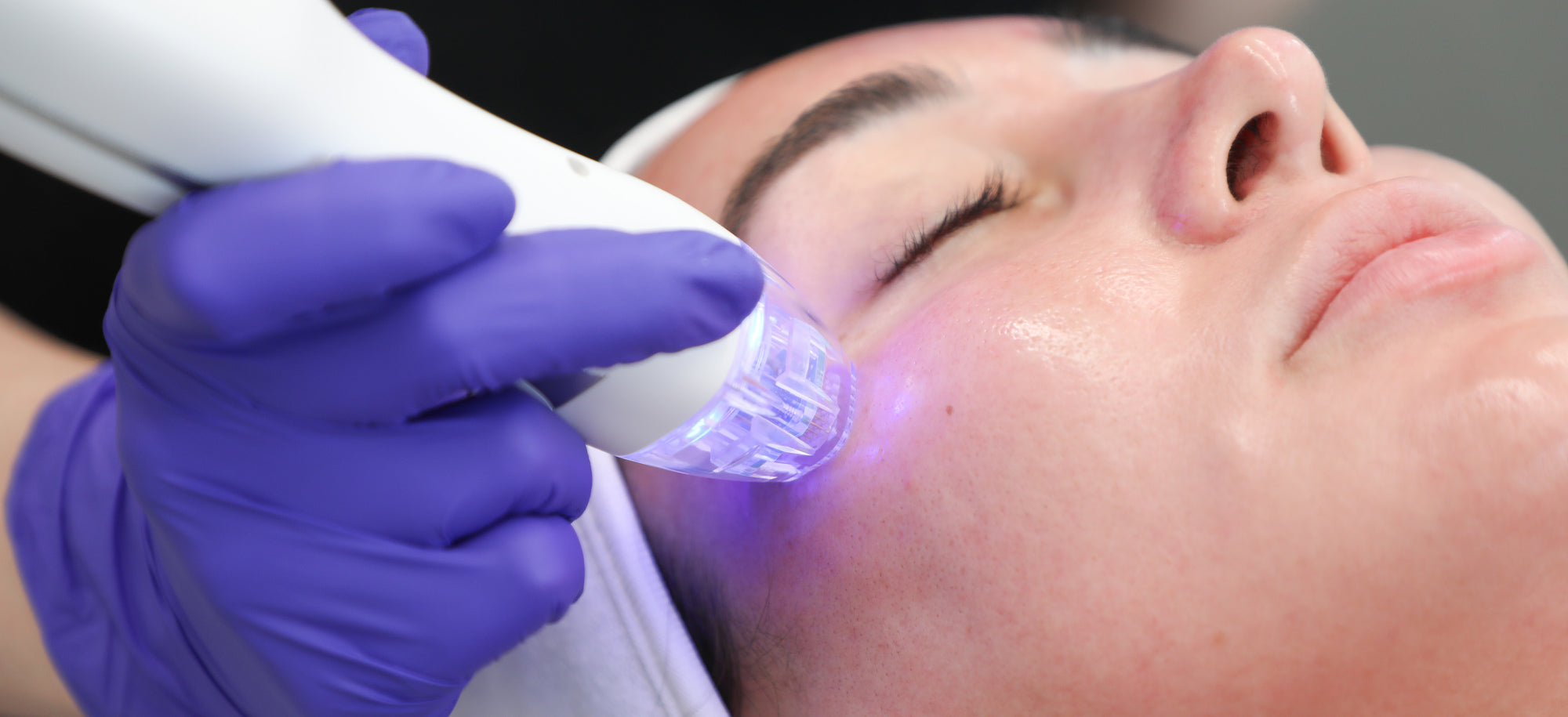 microneedling near patient's upper cheek area