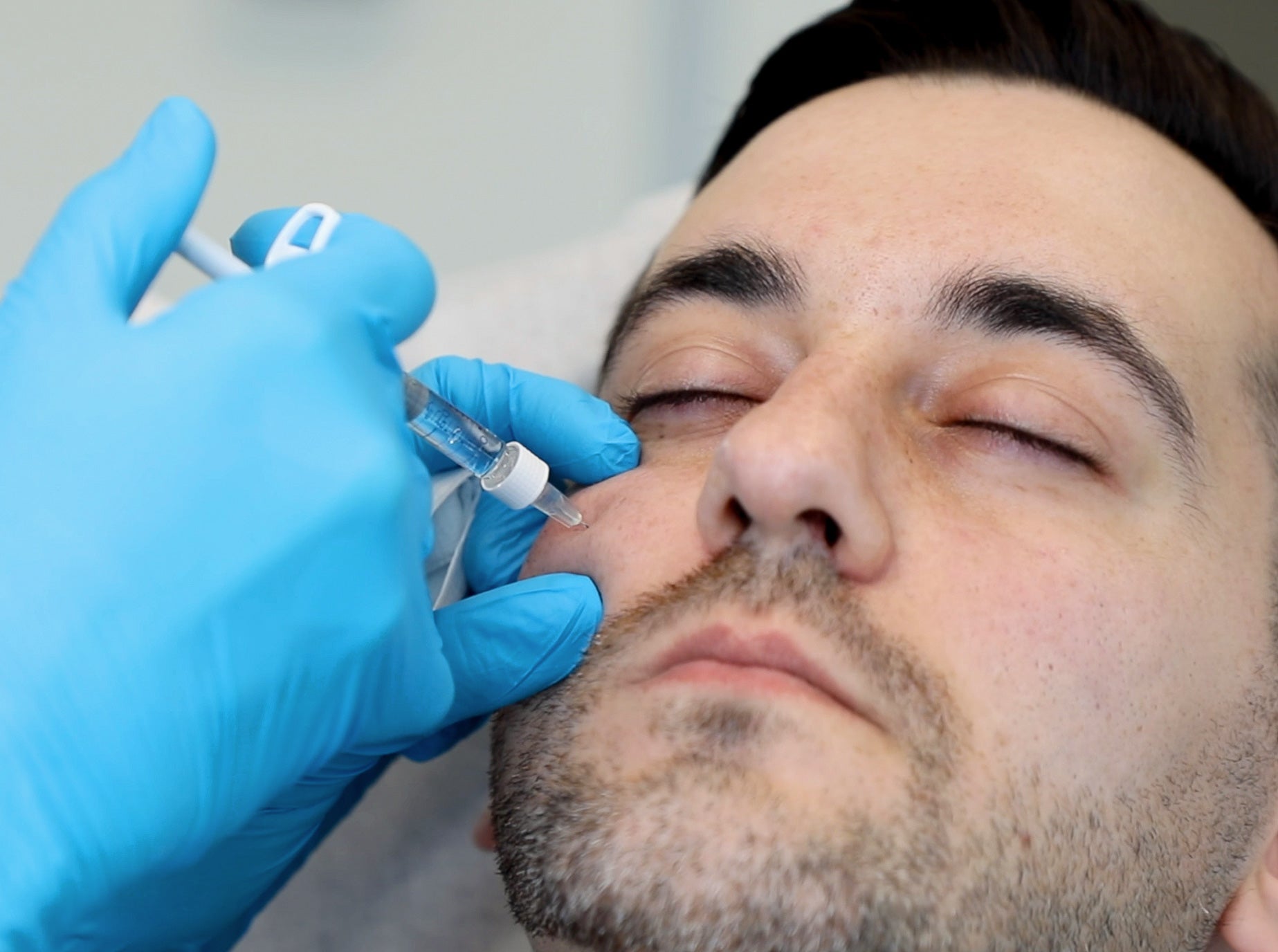 cheek filler injection into male patient