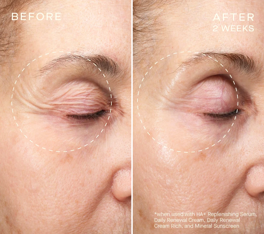 VOLUME RECOVERY SET Before and After