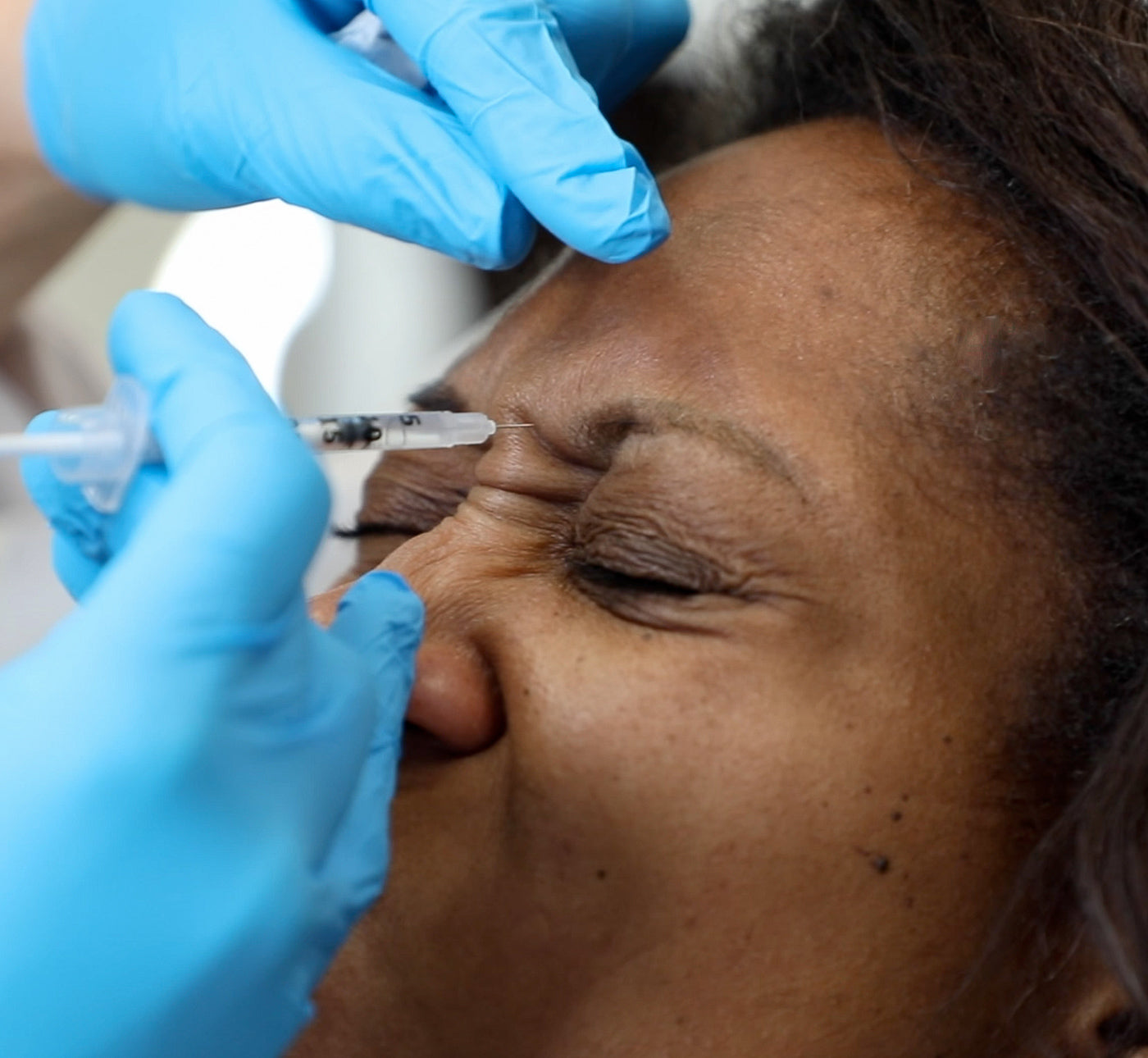 provider injecting into patient's facial furrows