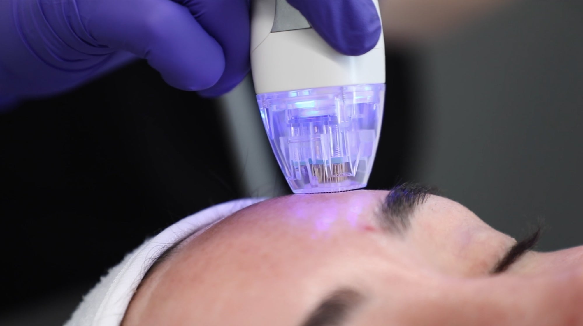 close up of microneedling tool on forehead